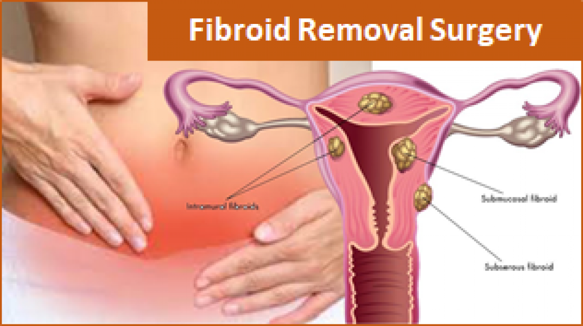Affordable Cost Fibroid Treatment in India